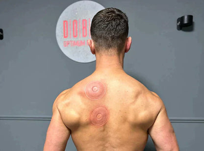 Smart Cupping Therapy Device